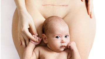 Nascita del bambino + Dopo la nascita + intervento di parto cesareo