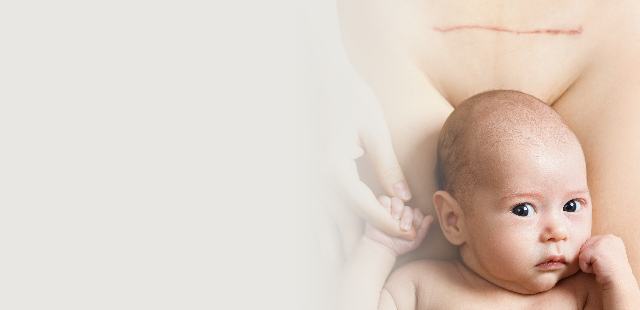 Nascita del bambino + Dopo la nascita + intervento di parto cesareo